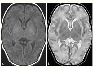 Brain MRI